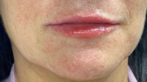 Lip Fillers Before and After Pictures in Buffalo, NY