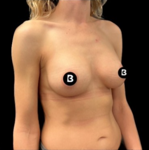 Breast Augmentation Before and After Pictures in Buffalo, NY