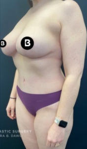 Mommy Makeover Before and After Pictures in Buffalo, NY