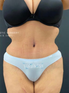 Abdominoplasty (Tummy Tuck) Before and After Pictures in Buffalo, NY