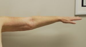 Arm Liposuction Before and After Pictures Buffalo, NY