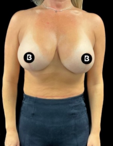 Breast Augmentation Before and After Pictures in Buffalo, NY