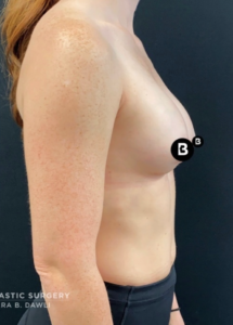 Breast Augmentation Before and After Pictures in Buffalo, NY
