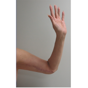 Brachioplasty (Arm Lift) Before and After Pictures Buffalo, NY