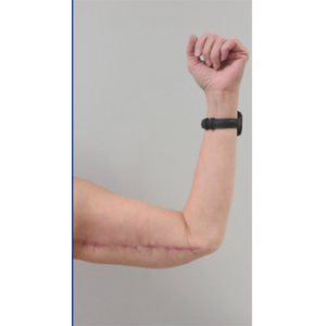 Brachioplasty (Arm Lift) Before and After Pictures Buffalo, NY