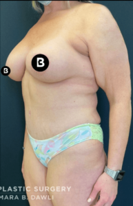 Mommy Makeover Before and After Pictures in Buffalo, NY