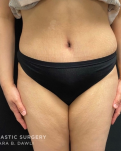 Abdominoplasty (Tummy Tuck) Before and After Pictures in Buffalo, NY