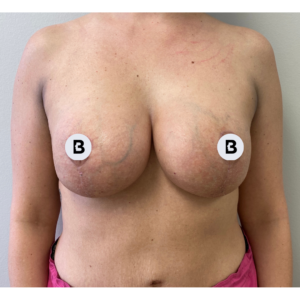 Breast Augmentation Before and After Pictures Buffalo, NY