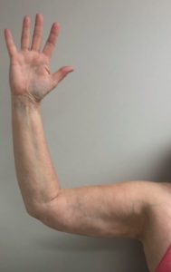Arm Liposuction Before and After Pictures Buffalo, NY