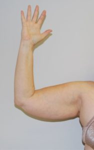 Arm Liposuction Before and After Pictures Buffalo, NY