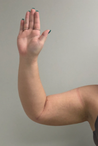 Arm Liposuction Before and After Pictures Buffalo, NY