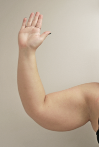 Arm Liposuction Before and After Pictures Buffalo, NY