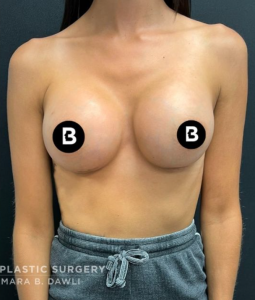 Breast Augmentation Before and After Pictures in Buffalo, NY