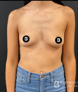 Breast Augmentation Before and After Pictures in Buffalo, NY