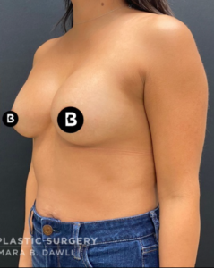 Breast Augmentation Before and After Pictures in Buffalo, NY