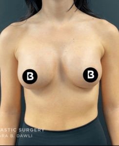 Breast Augmentation Before and After Pictures in Buffalo, NY