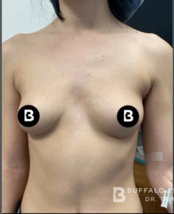 Breast Augmentation Before and After Pictures in Buffalo, NY