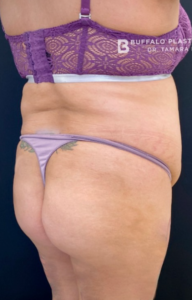 Brazilian Butt Lift Before and After Pictures in Buffalo, NY