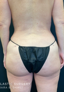 Brazilian Butt Lift Before and After Pictures in Buffalo, NY