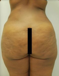Brazilian Butt Lift Before and After Pictures Buffalo, NY