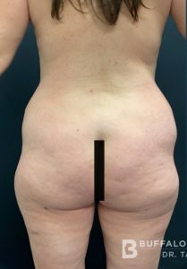Brazilian Butt Lift Before and After Pictures in Buffalo, NY