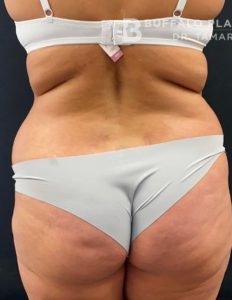 Brazilian Butt Lift Before and After Pictures in Buffalo, NY