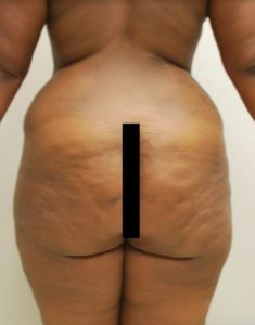 Brazilian Butt Lift Before and After Pictures Buffalo, NY