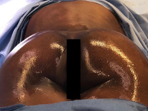 Brazilian Butt Lift Before and After Pictures Buffalo, NY