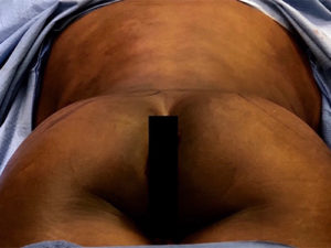 Brazilian Butt Lift Before and After Pictures Buffalo, NY