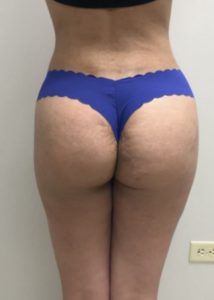 Brazilian Butt Lift Before and After Pictures Buffalo, NY