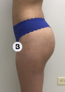 Brazilian Butt Lift Before and After Pictures Buffalo, NY