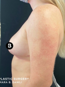 Mastopexy (Breast Lift) Before and After Pictures in Buffalo, NY