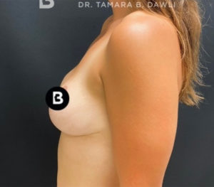 Mastopexy (Breast Lift) Before and After Pictures in Buffalo, NY