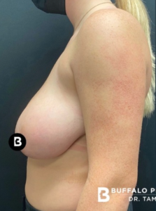 Mastopexy (Breast Lift) Before and After Pictures in Buffalo, NY
