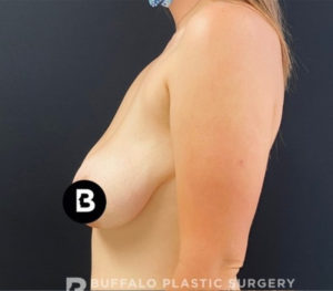 Mastopexy (Breast Lift) Before and After Pictures in Buffalo, NY