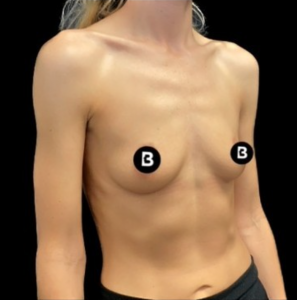 Breast Augmentation Before and After Pictures in Buffalo, NY