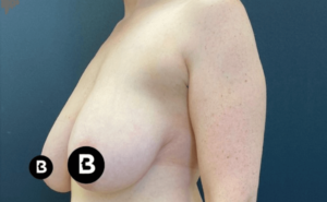 Breast Reduction Before and After Pictures in Buffalo, NY