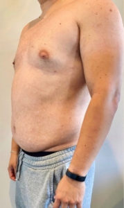 Liposuction Before and After Pictures in Buffalo, NY