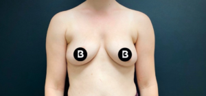 Breast Augmentation Before and After Pictures in Buffalo, NY