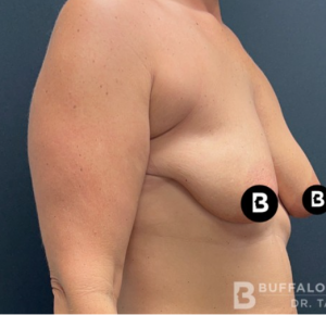 Mastopexy (Breast Lift) Before and After Pictures in Buffalo, NY