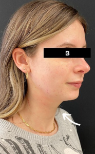Facial Fat transfer Before and After Pictures in Buffalo, NY