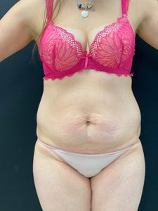 Abdominoplasty (Tummy Tuck) Before and After Pictures in Buffalo, NY