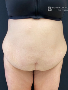 Abdominoplasty (Tummy Tuck) Before and After Pictures in Buffalo, NY