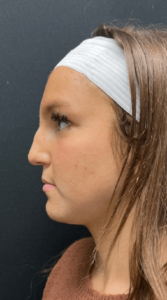 Liquid Rhinoplasty Before and After Pictures in Buffalo, NY