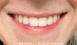 Lip Fillers Before and After Pictures in Buffalo, NY
