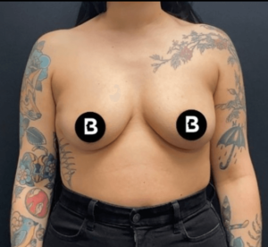 Mommy Makeover Before and After Pictures in Buffalo, NY