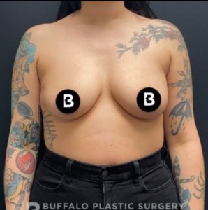 Breast Augmentation Before and After Pictures in Buffalo, NY