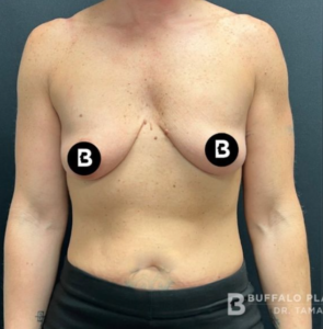 Breast Augmentation Before and After Pictures in Buffalo, NY
