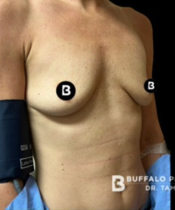 Breast Augmentation Before and After Pictures in Buffalo, NY