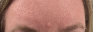 Mole Removal Before and After Pictures Buffalo, NY